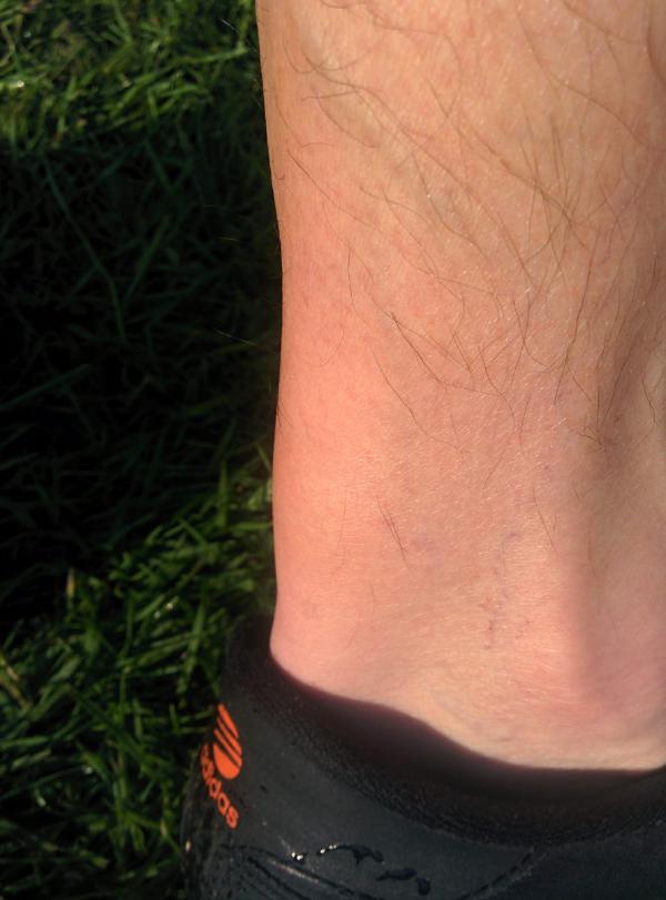 A close-up photograph of a person’s lower leg and ankle showing what appears to be an injury or medical condition affecting the Achilles tendon area. The skin appears reddened or inflamed, and the person is wearing dark colored cycling shoes with visible branding.